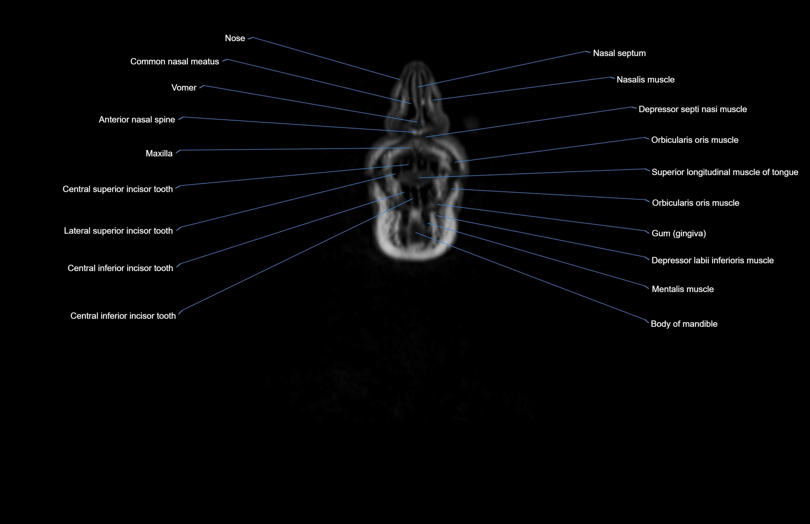 Neck coronal cross sectional MRI anatomy 3T MRI  image-img-00001-00077.webp